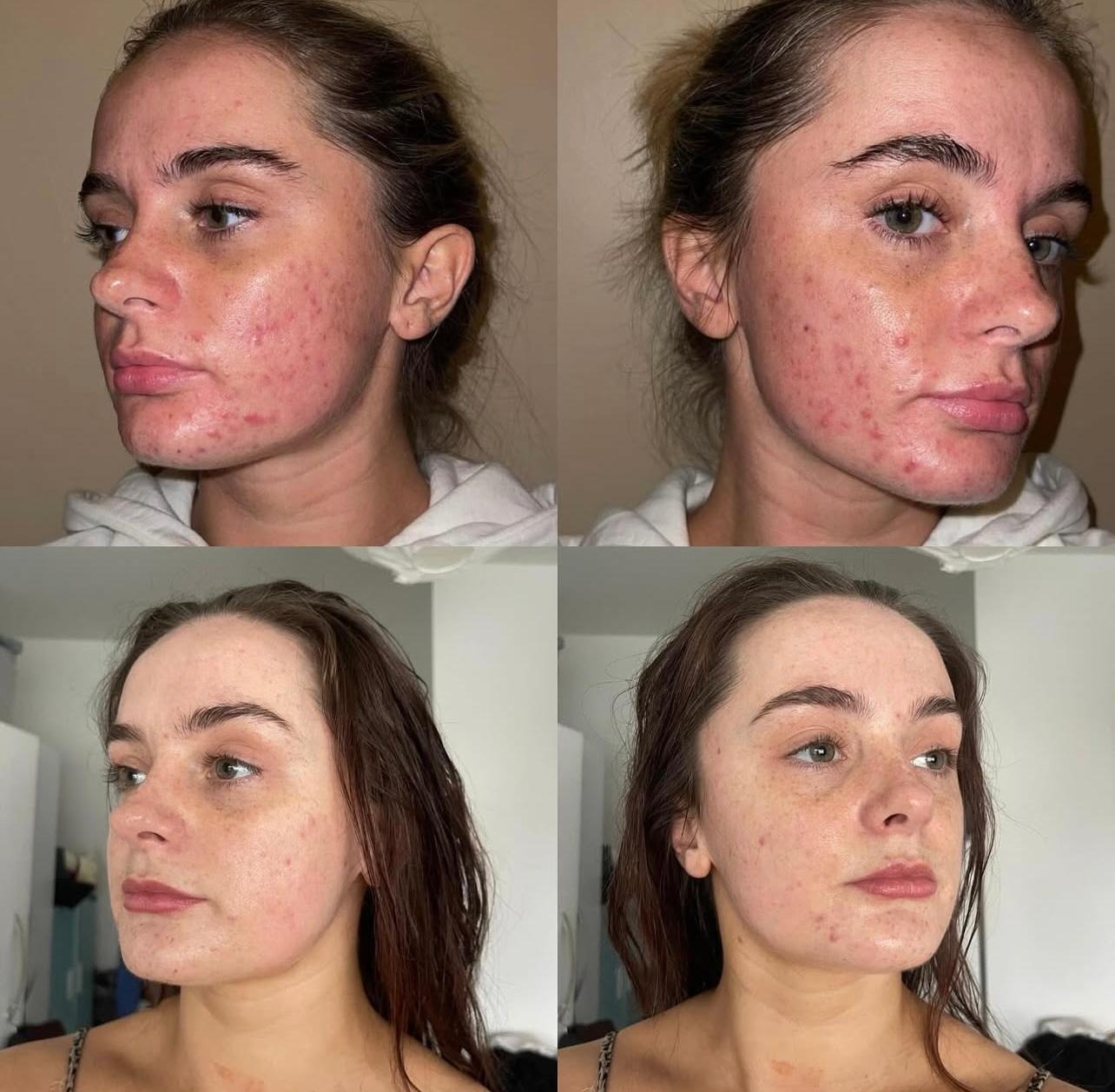 Visible reduction in breakouts after a treatment course