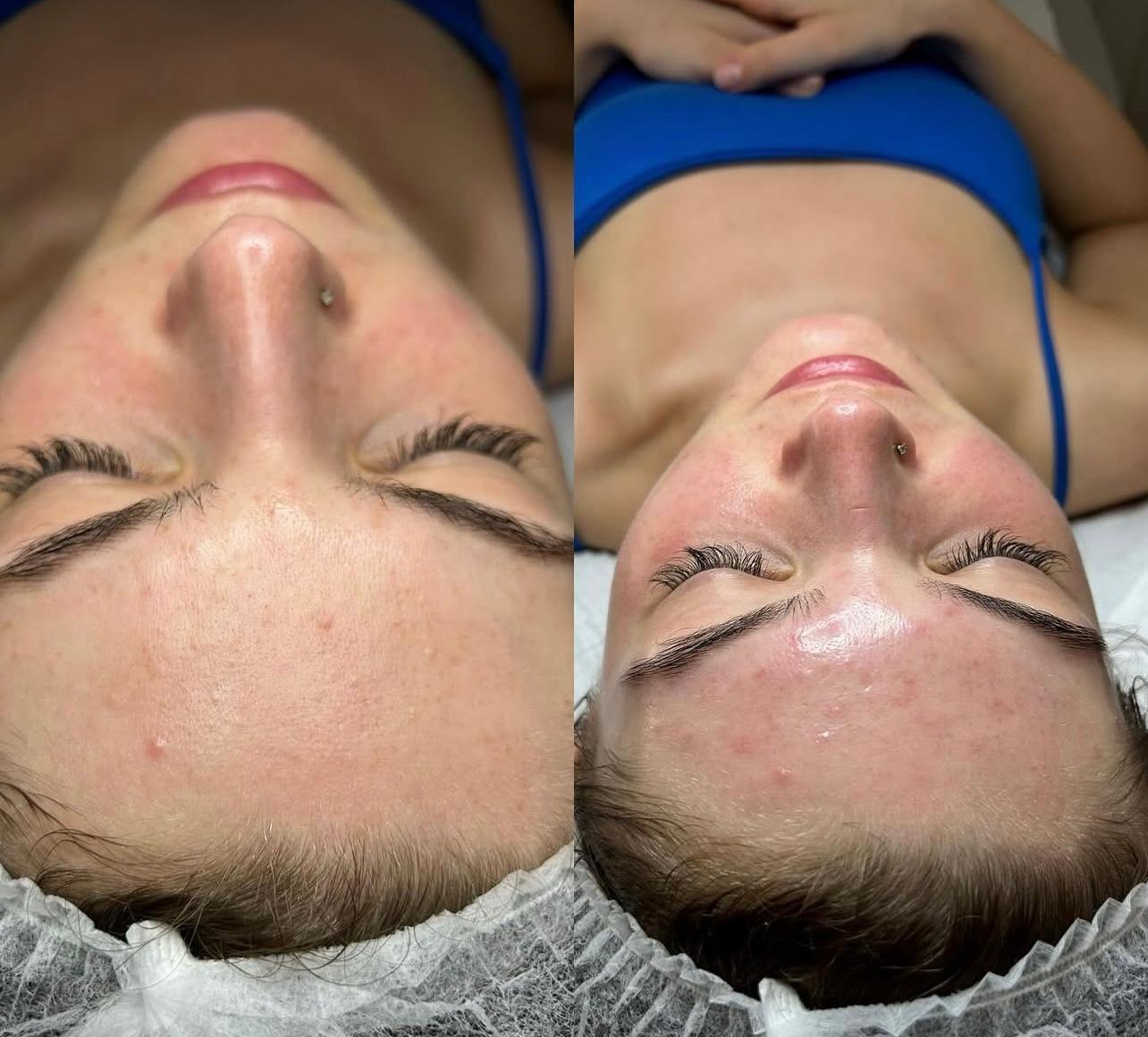 Improved skin clarity and texture after AlumierMD peels