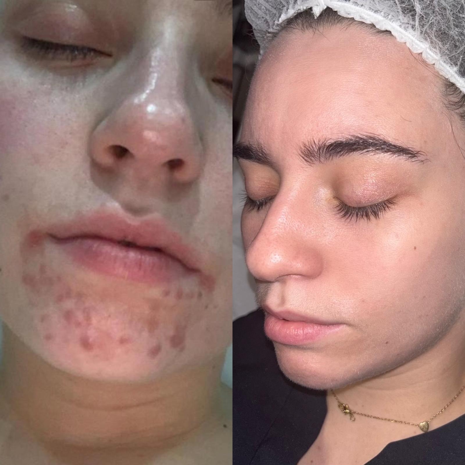 Skin tone and radiance after SkinPen microneedling course
